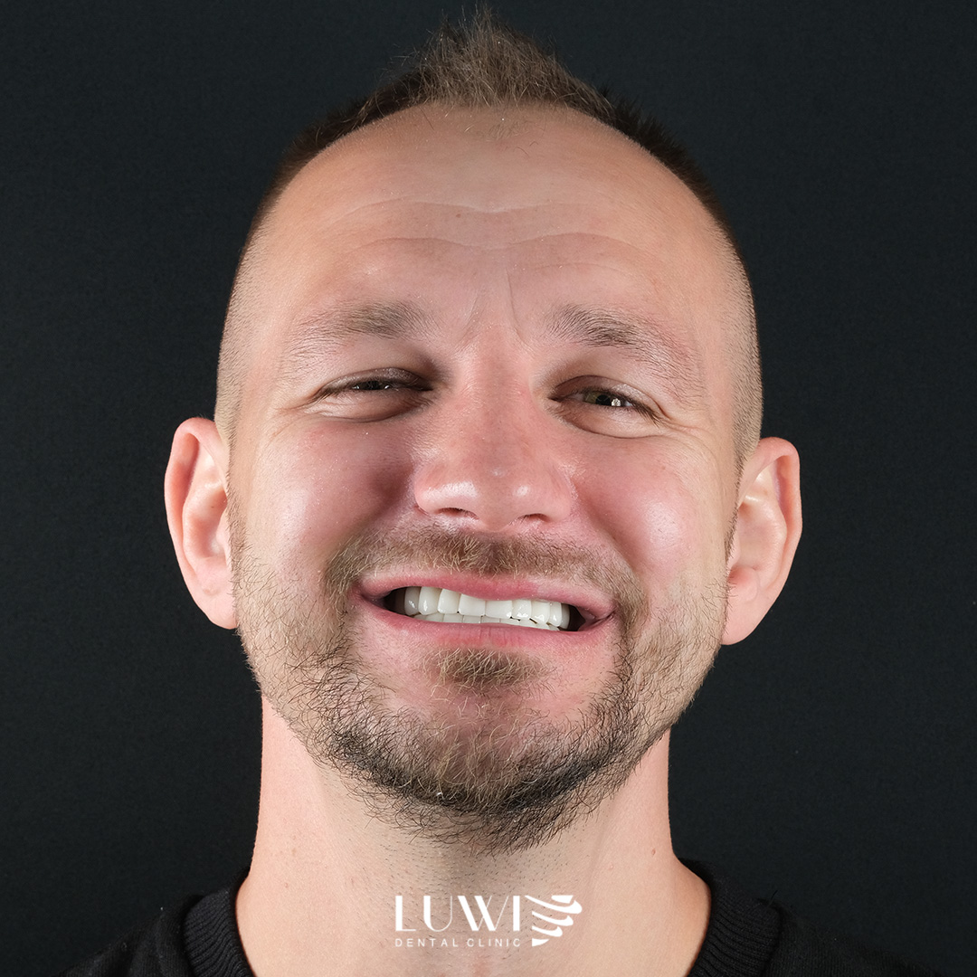 Smile Makeover - Luwi Dental Clinic