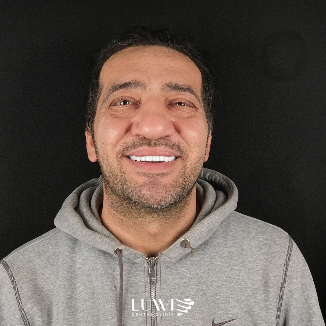 All-on-4 Implants before and after