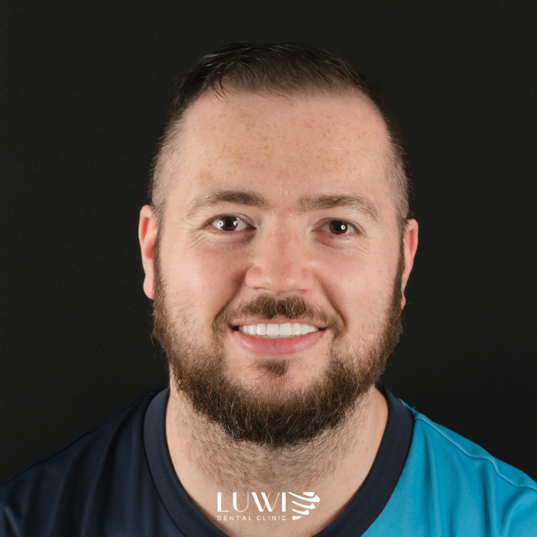 Composite Bonding before and after