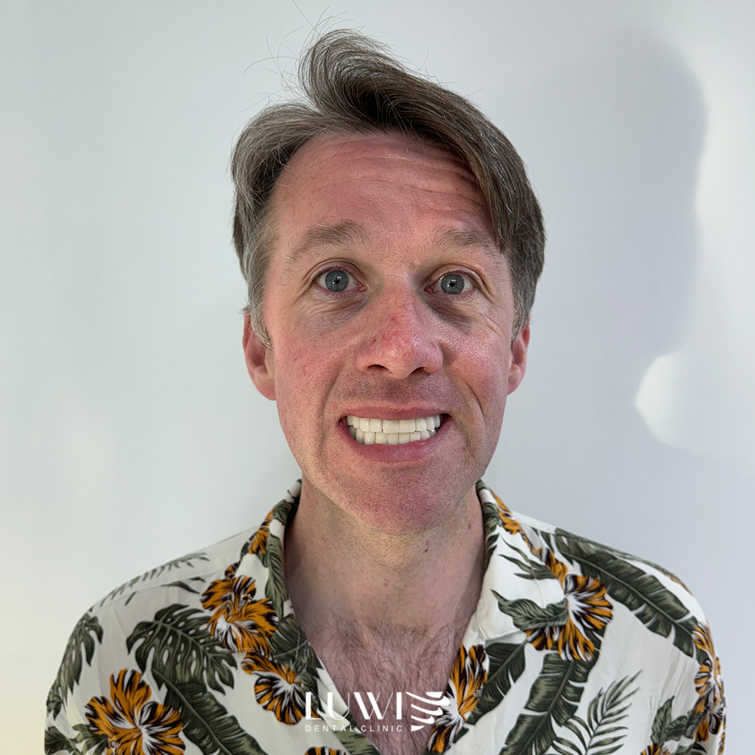 Porcelain Veneers before and after