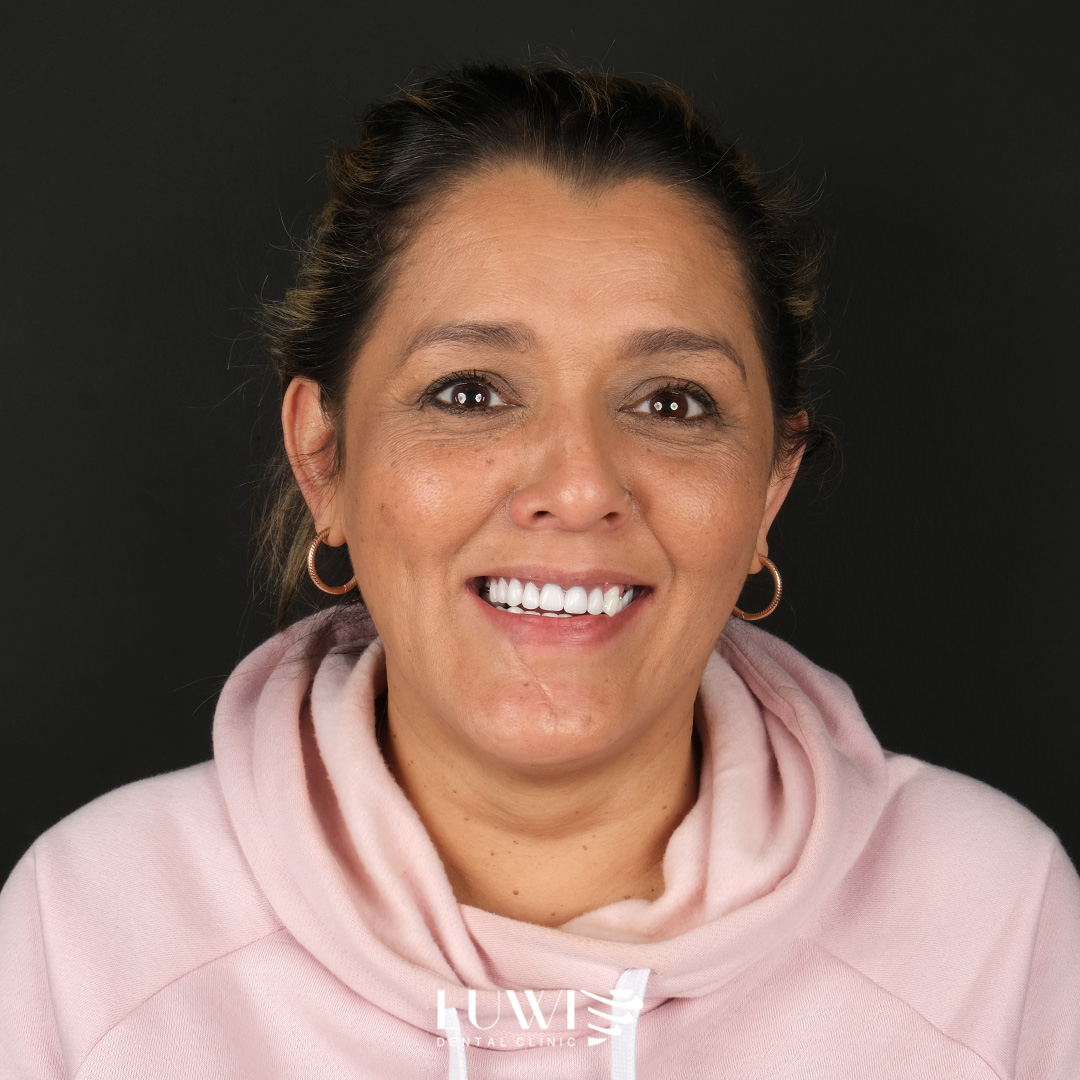 Hollywood Smile - Luwi Dental Clinic