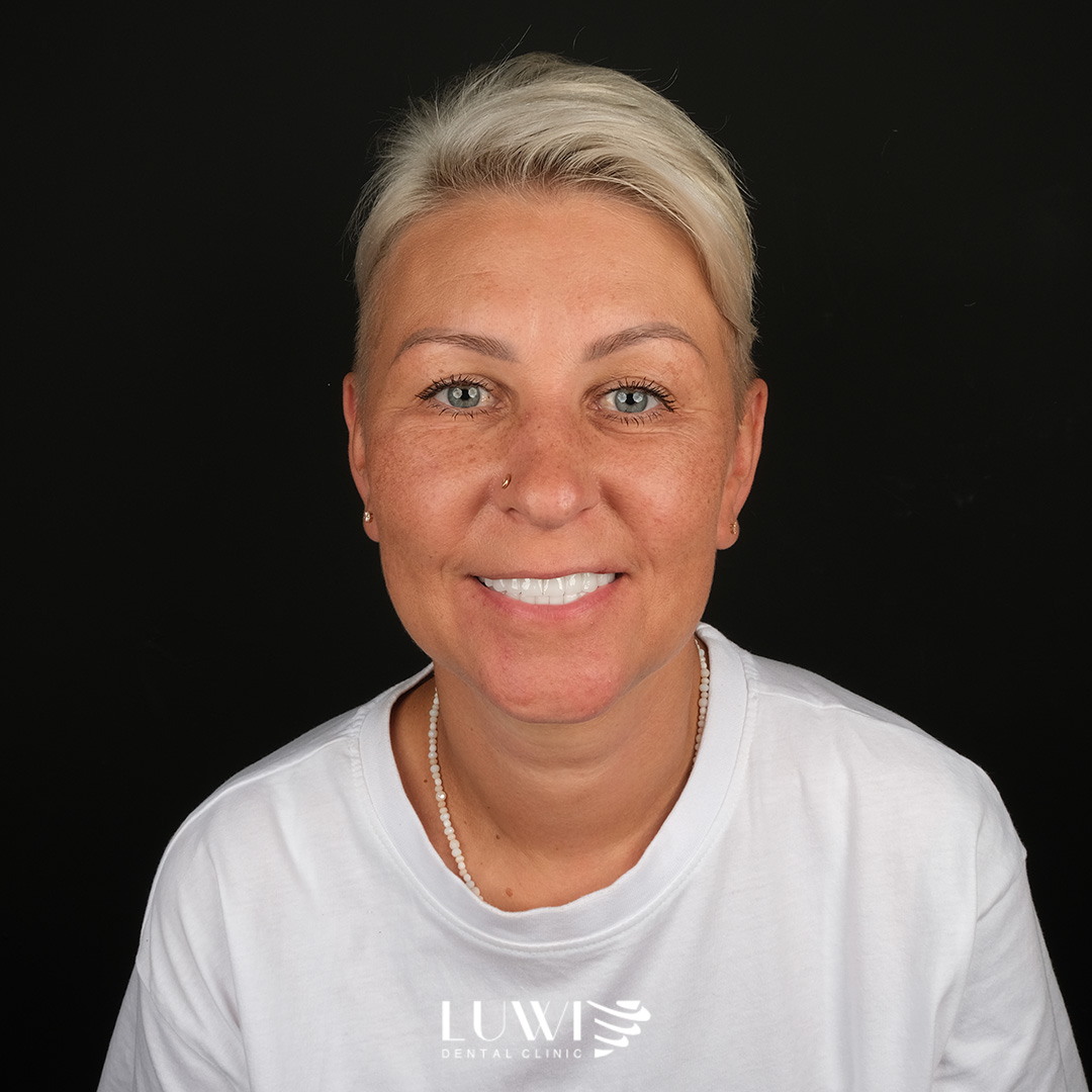 All-on-6 Implants - Luwi Dental Clinic