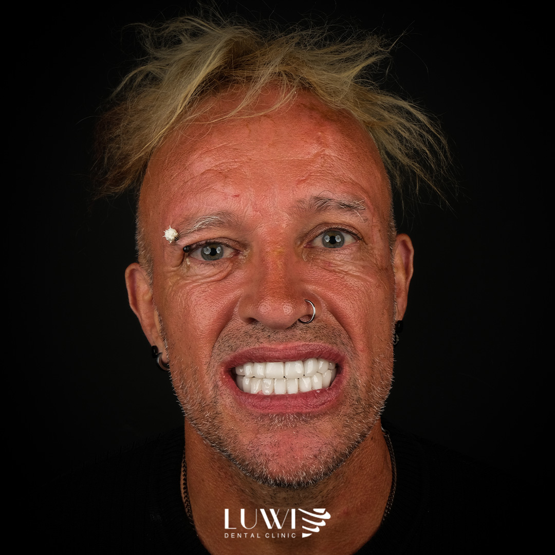 Full Mouth Restoration before and after