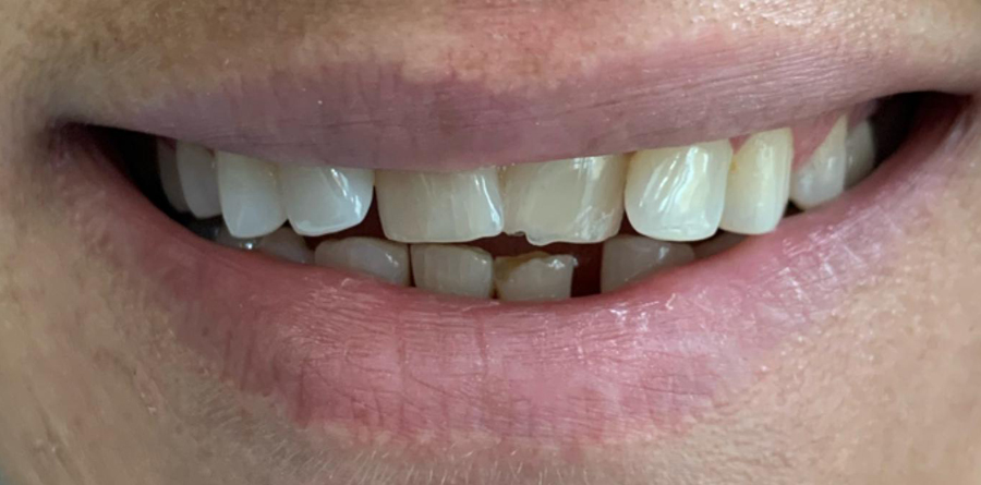Gum Treatment - Tasarım Dental Clinic