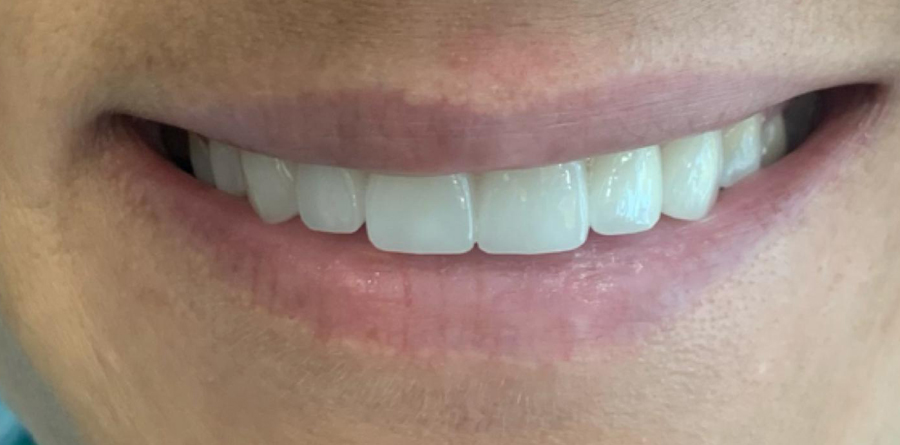Invisalign before and after