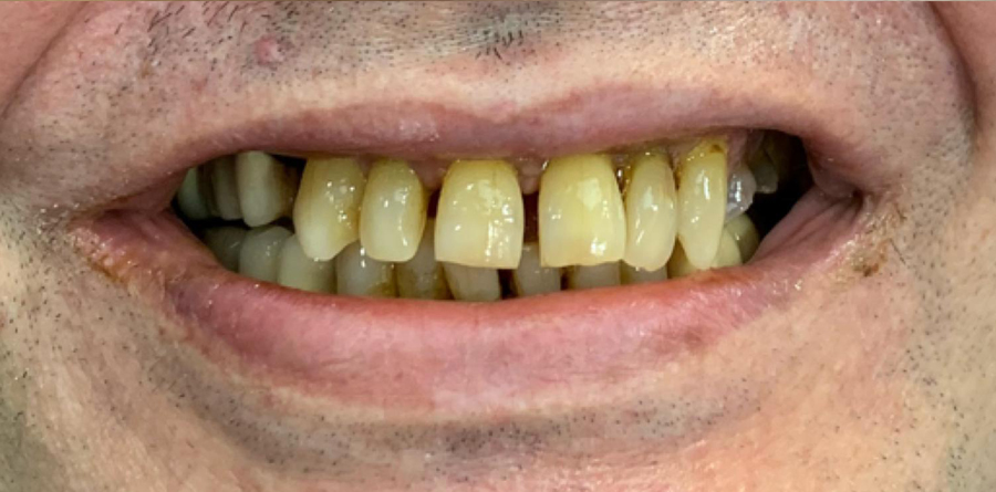 Root Canal Treatment before and after