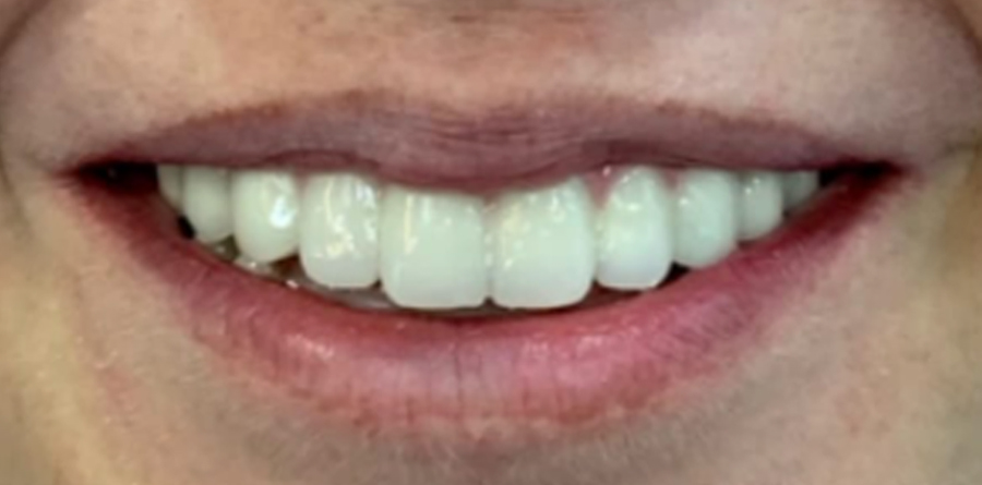 Full Mouth Restoration before and after