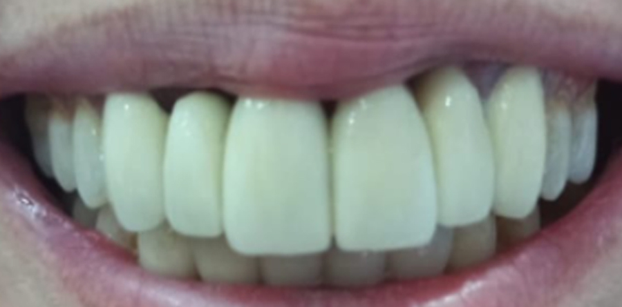 Cosmetic Dentistry before and after