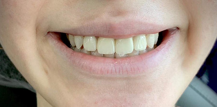 Porcelain Crowns - Tasarım Dental Clinic