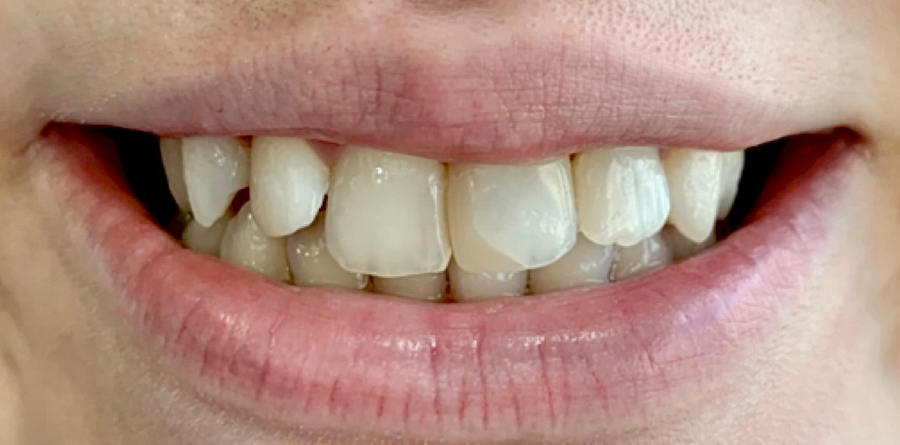 Teeth Whitening - Tasarım Dental Clinic