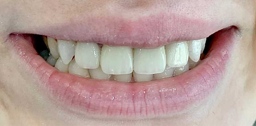 Orthodontic Treatment - Tasarım Dental Clinic