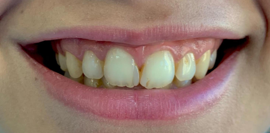 Dental Implants - Tasarım Dental Clinic