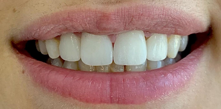 Zirconium Crowns - Tasarım Dental Clinic