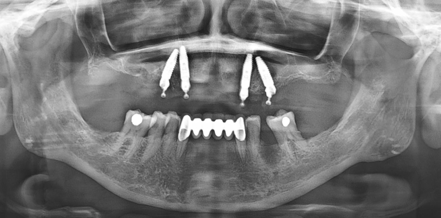 Aesthetic Fillings - Tasarım Dental Clinic