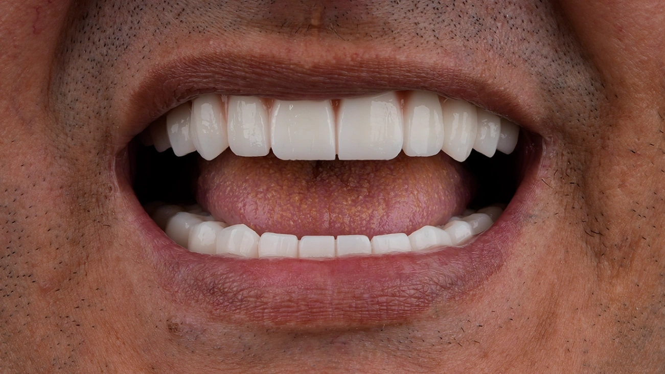 After Hollywood Smile - Vitrin Clinic