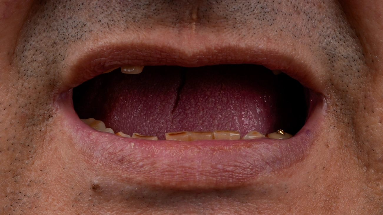 Before Hollywood Smile - Vitrin Clinic