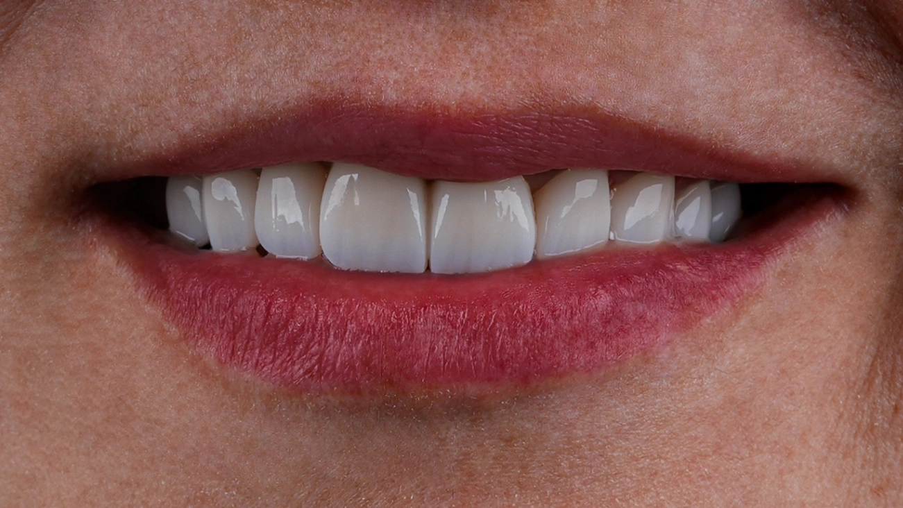 After Dental Veneers - Vitrin Clinic