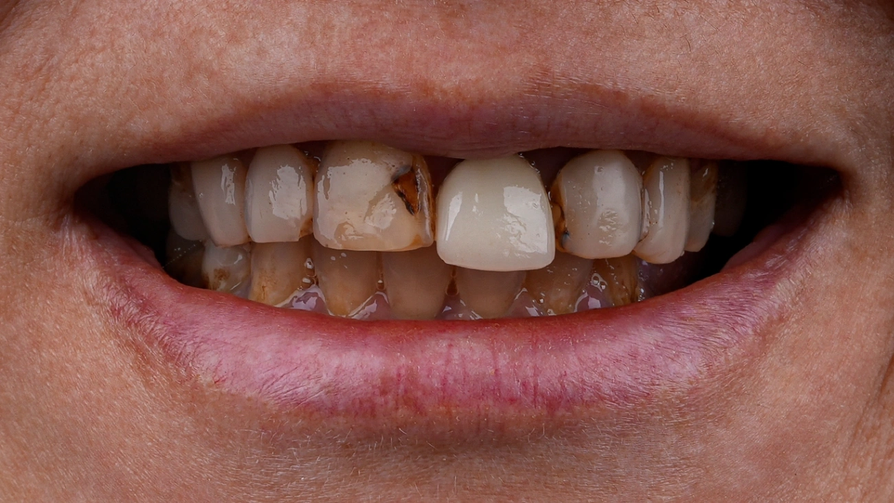 Before Dental Veneers - Vitrin Clinic