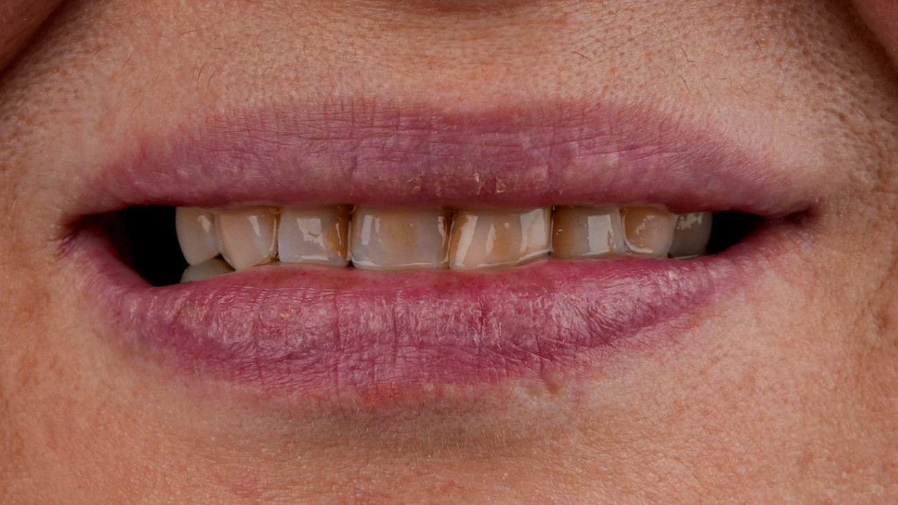 Before Hollywood Smile - Vitrin Clinic