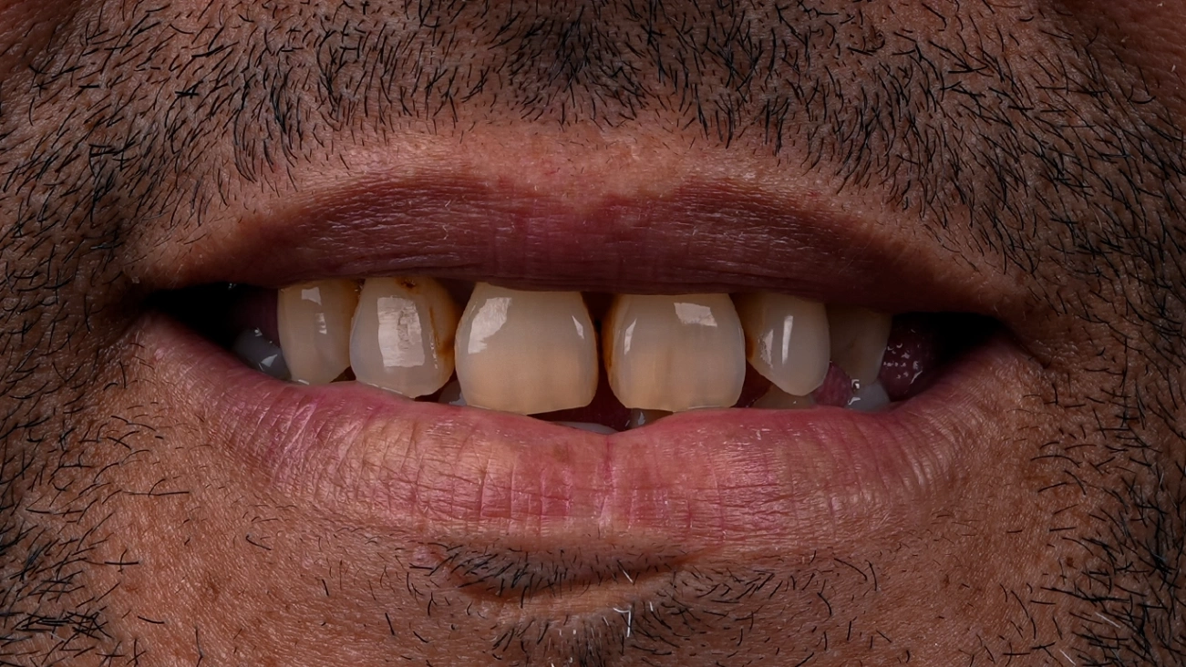 Before Zirconia Crowns - Vitrin Clinic