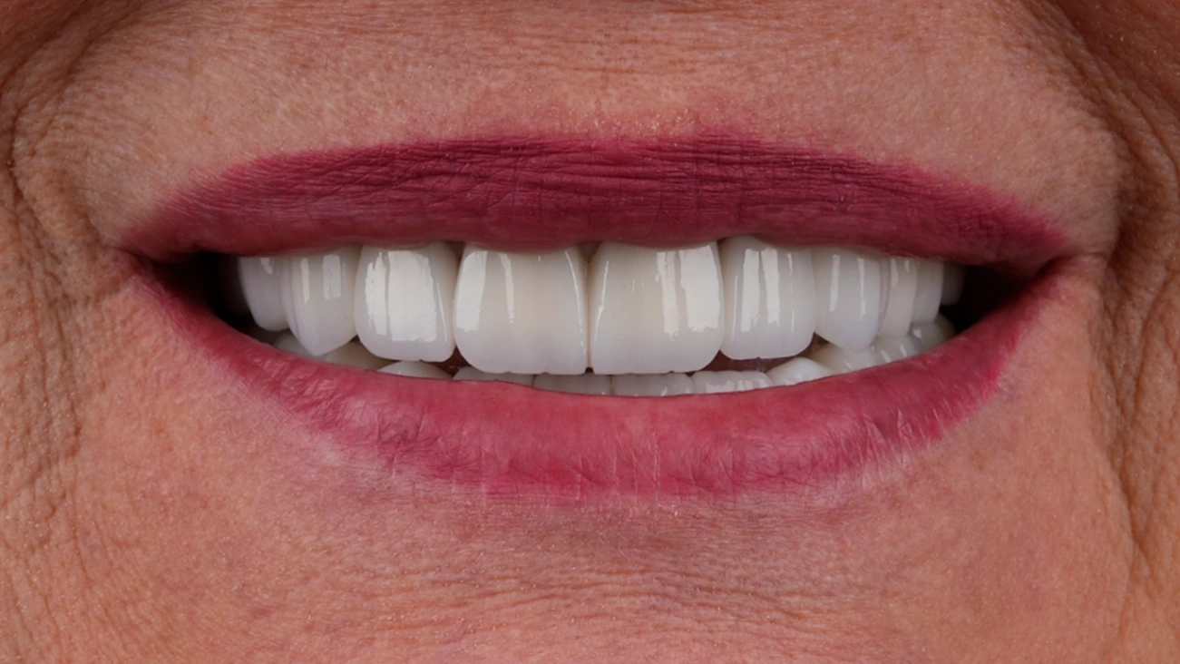 After Dental Implants - Vitrin Clinic