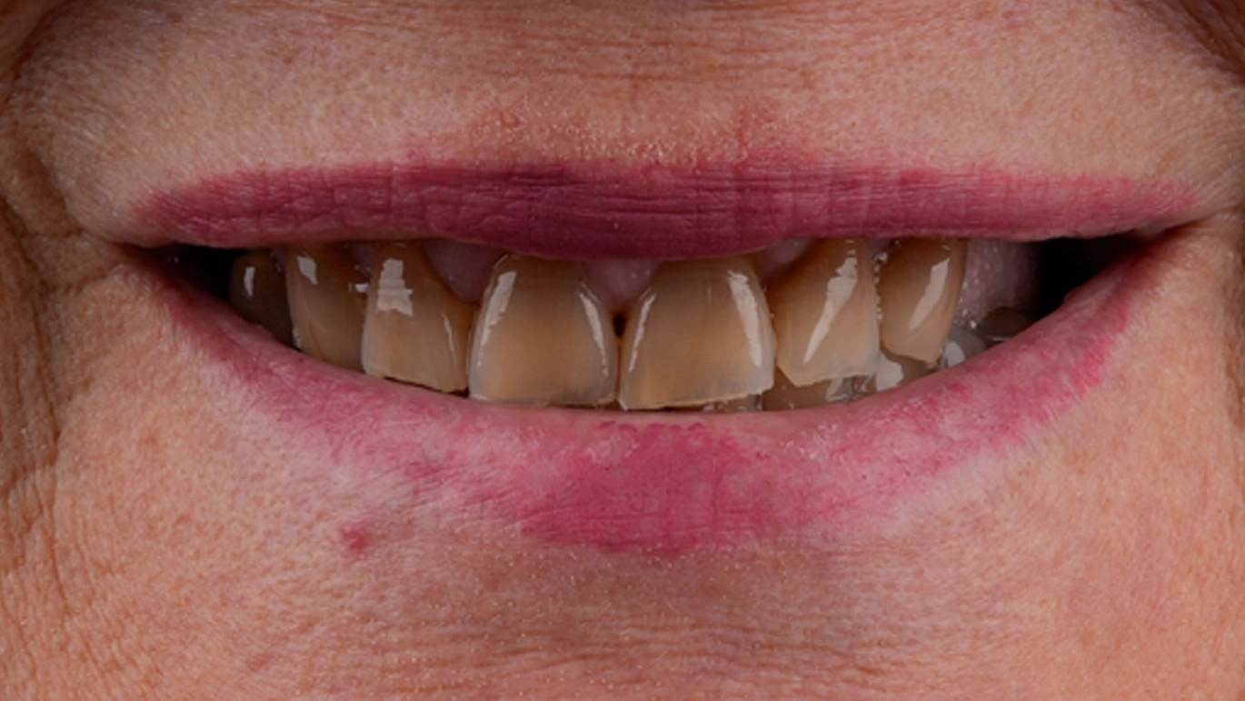 Before Dental Implants - Vitrin Clinic